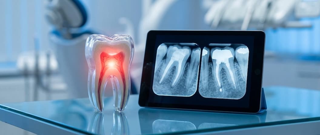 Root Canal Treatment - Dental service at Prime Dental