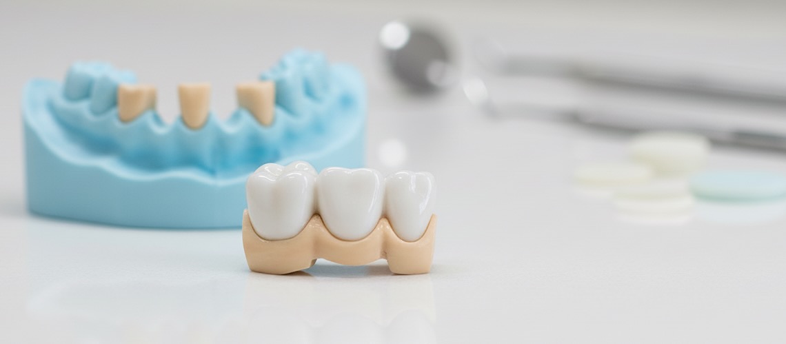 Dental Bridges - Dental service at Prime Dental