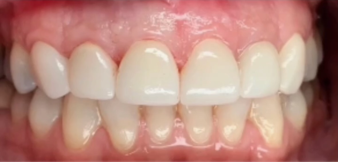 After Porcelain Dental Veneers treatment in Baldwin Park, El Monte, La Crescenta, and 5 more LA County cities - restored natural-looking tooth at Prime Dental